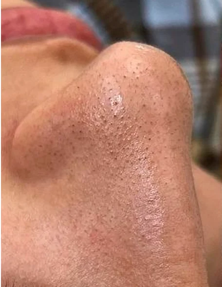 Pele do nariz de paciente, em detalhe