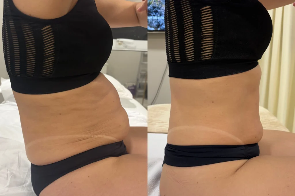 Capa do artigo: Diástase abdominal: o que é, sintomas e como tratar sem cirurgia