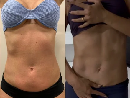 Antes e depois de criomodelagem no abdômen, vista frontal