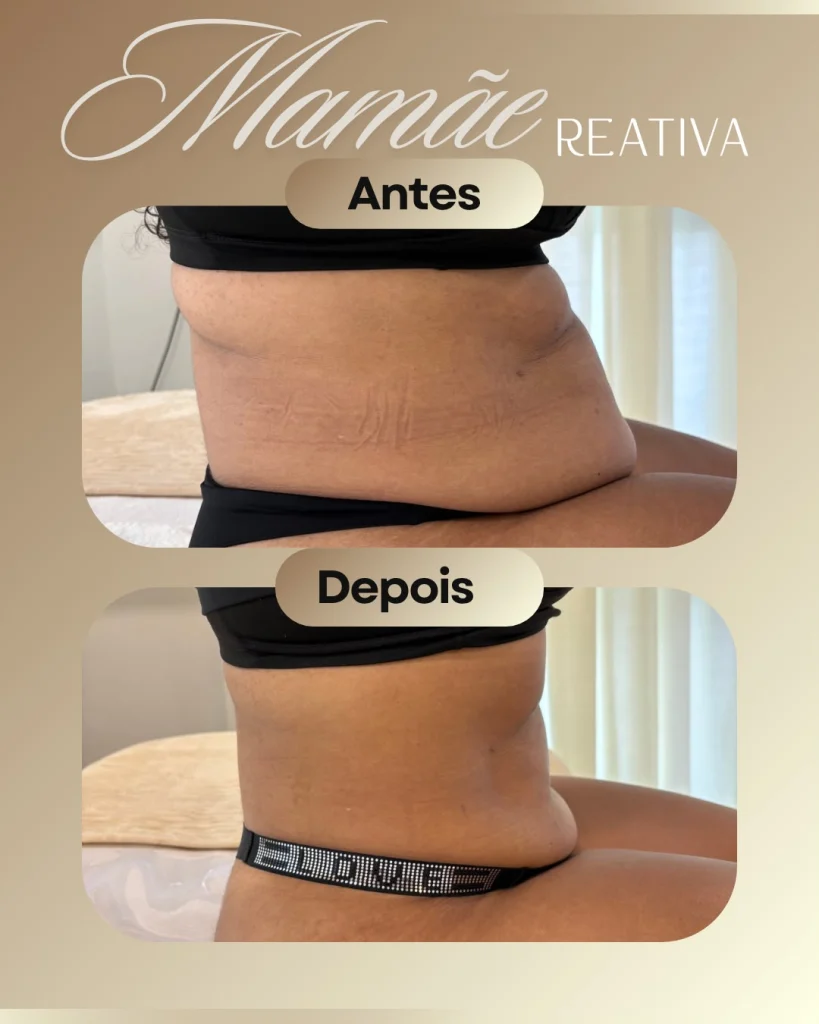 Mamãe Reativa: antes e depois do abdômen, vista lateral