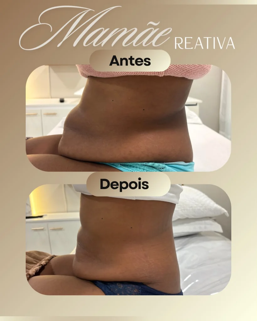 Mamãe Reativa: antes e depois do abdômen e flanco, vista lateral