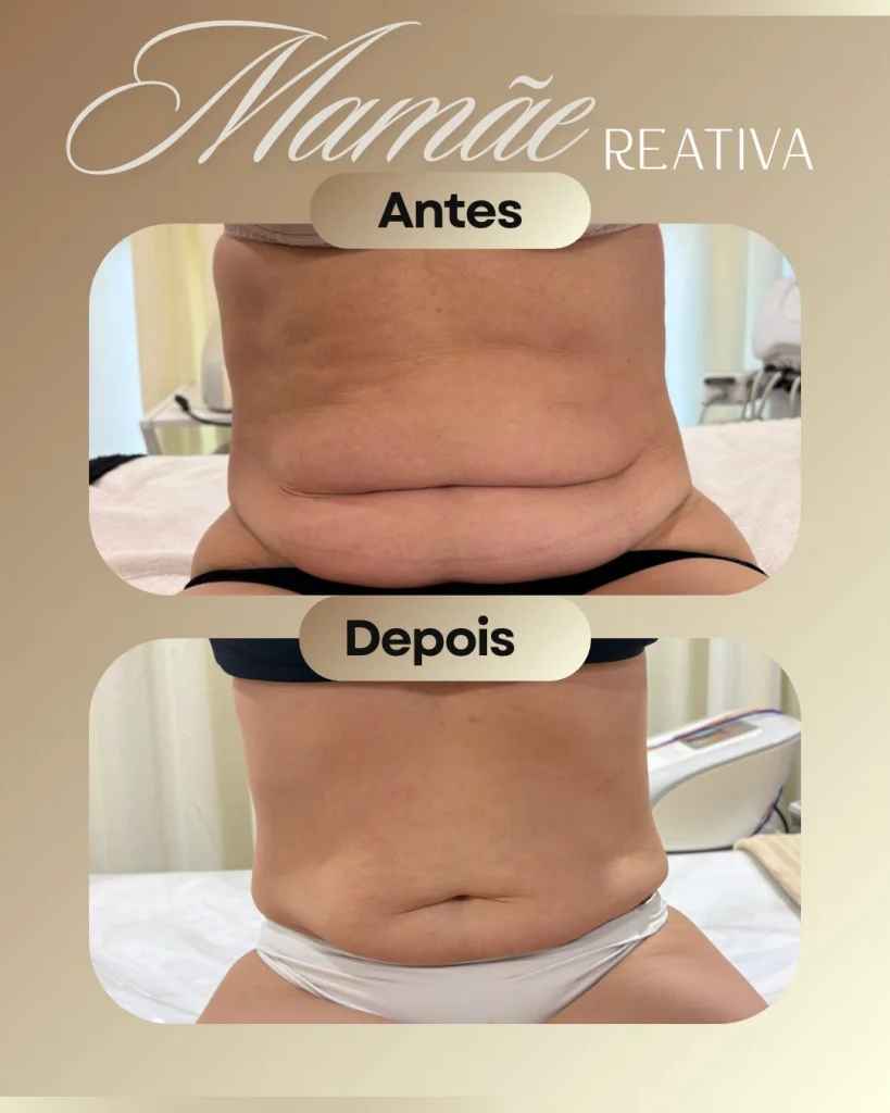 Mamãe Reativa: antes e depois do abdômen, vista frontal