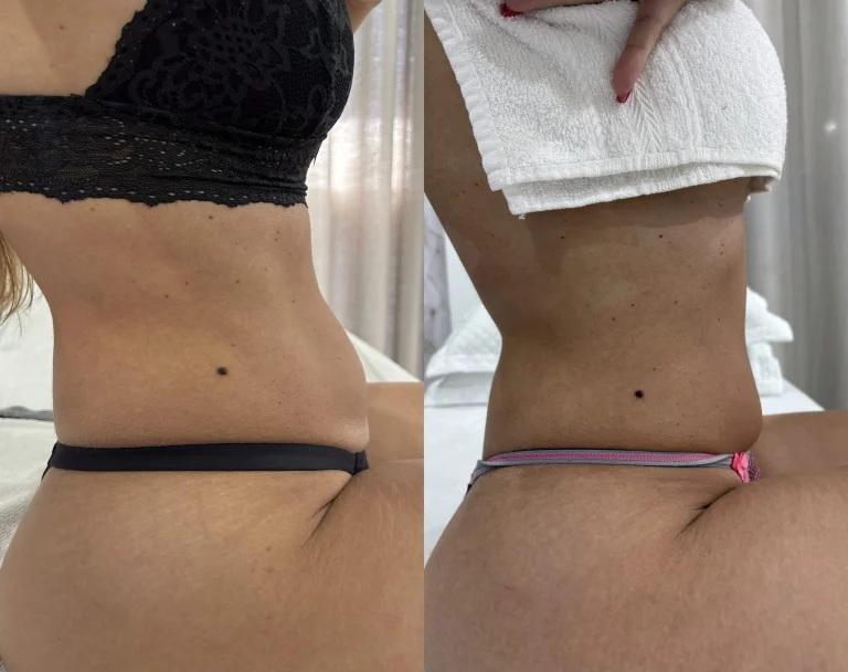 Antes e depois de criomodelagem no abdômen, vista lateral