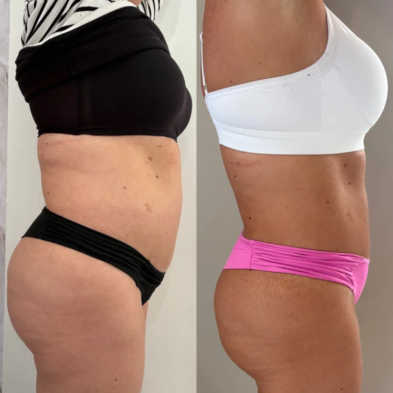 Antes e depois de criomodelagem no abdômen e culote